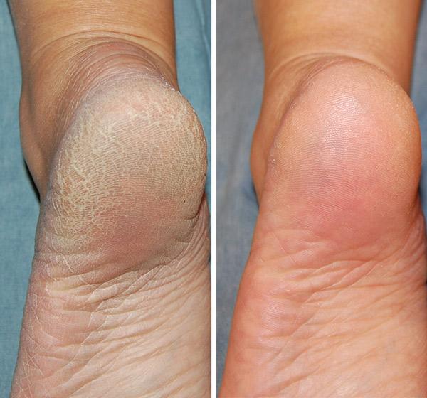 callus 3