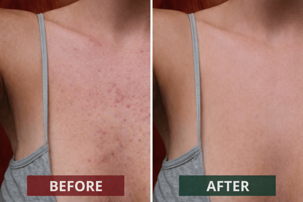 clear skin transformation before and after (1)